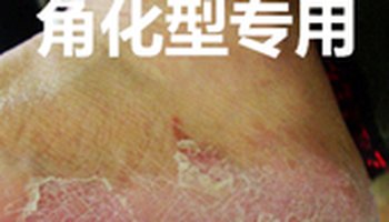 鳞屑角化型脚气