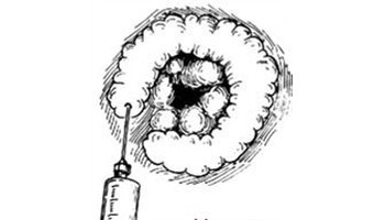 痔核脱出 prolapse of hemorrhoids,痔核就是痔疮在压力和重力作用