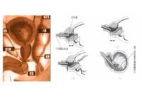 经尿道前列腺刮除手术