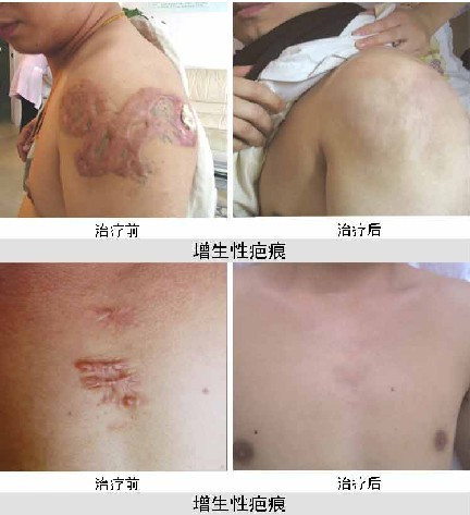为什么会有增生性疤痕?