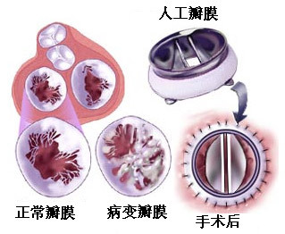 心脏瓣膜手术 360搜索
